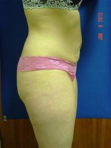 Liposuction Before Photo by Vincent Lepore, Jr., MD; San Jose, CA - Case 29709