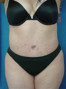 Tummy Tuck After Photo by Vincent Lepore, Jr.,  MD; San Jose, CA - Case 29715
