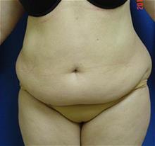 Tummy Tuck Before Photo by Vincent Lepore, Jr.,  MD; San Jose, CA - Case 29715