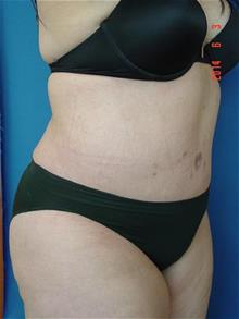 Tummy Tuck After Photo by Vincent Lepore, Jr.,  MD; San Jose, CA - Case 29715
