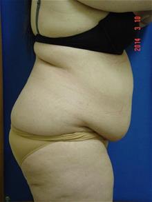 Tummy Tuck Before Photo by Vincent Lepore, Jr.,  MD; San Jose, CA - Case 29715