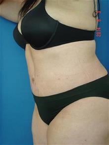 Tummy Tuck After Photo by Vincent Lepore, Jr.,  MD; San Jose, CA - Case 29715