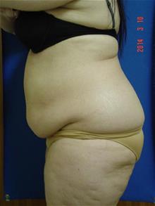 Tummy Tuck Before Photo by Vincent Lepore, Jr.,  MD; San Jose, CA - Case 29715