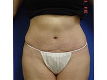 Tummy Tuck After Photo by Vincent Lepore, Jr.,  MD; San Jose, CA - Case 29716