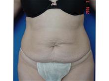 Tummy Tuck Before Photo by Vincent Lepore, Jr.,  MD; San Jose, CA - Case 29716