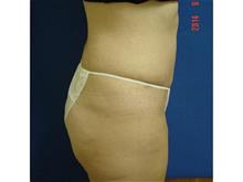 Tummy Tuck After Photo by Vincent Lepore, Jr.,  MD; San Jose, CA - Case 29716