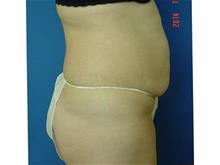 Tummy Tuck Before Photo by Vincent Lepore, Jr.,  MD; San Jose, CA - Case 29716
