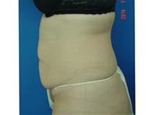 Tummy Tuck Before Photo by Vincent Lepore, Jr.,  MD; San Jose, CA - Case 29716