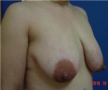 Breast Lift Before Photo by Vincent Lepore, Jr.,  MD; San Jose, CA - Case 41682