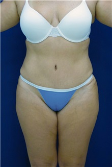 Tummy Tuck After Photo by Ricardo Rodriguez, MD; Lutherville-Timonium, MD - Case 26844
