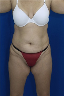 Tummy Tuck Before Photo by Ricardo Rodriguez, MD; Lutherville-Timonium, MD - Case 26844