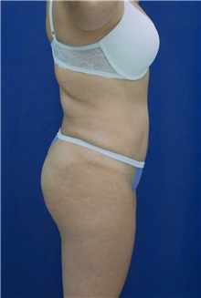 Tummy Tuck After Photo by Ricardo Rodriguez, MD; Lutherville-Timonium, MD - Case 26844