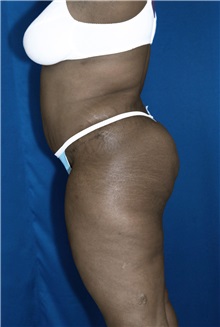Tummy Tuck After Photo by Ricardo Rodriguez, MD; Lutherville-Timonium, MD - Case 26845