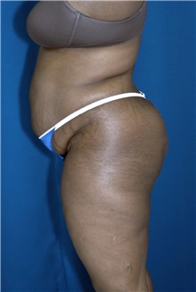 Tummy Tuck Before Photo by Ricardo Rodriguez, MD; Lutherville-Timonium, MD - Case 26845