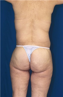 Body Contouring After Photo by Ricardo Rodriguez, MD; Lutherville-Timonium, MD - Case 26880