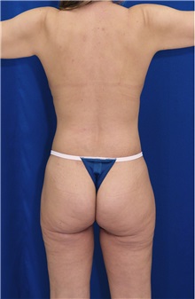 Body Contouring After Photo by Ricardo Rodriguez, MD; Lutherville-Timonium, MD - Case 26882