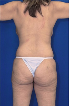 Body Contouring Before Photo by Ricardo Rodriguez, MD; Lutherville-Timonium, MD - Case 26882