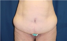Body Contouring Before Photo by Ricardo Rodriguez, MD; Lutherville-Timonium, MD - Case 26883