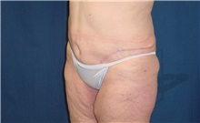 Body Contouring After Photo by Ricardo Rodriguez, MD; Lutherville-Timonium, MD - Case 26883