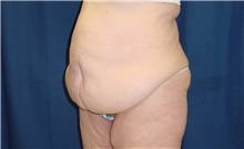 Body Contouring Before Photo by Ricardo Rodriguez, MD; Lutherville-Timonium, MD - Case 26883