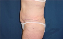 Body Contouring After Photo by Ricardo Rodriguez, MD; Lutherville-Timonium, MD - Case 26883
