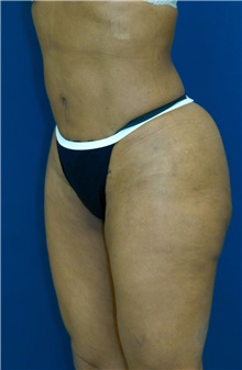 Buttock Implants After Photo by Ricardo Rodriguez, MD; Lutherville-Timonium, MD - Case 26887