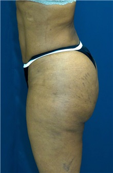 Buttock Implants After Photo by Ricardo Rodriguez, MD; Lutherville-Timonium, MD - Case 26887