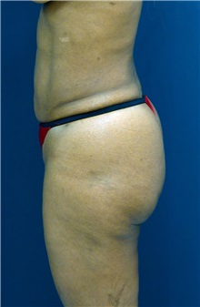 Buttock Implants Before Photo by Ricardo Rodriguez, MD; Lutherville-Timonium, MD - Case 26887