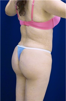 Buttock Implants After Photo by Ricardo Rodriguez, MD; Lutherville-Timonium, MD - Case 26888