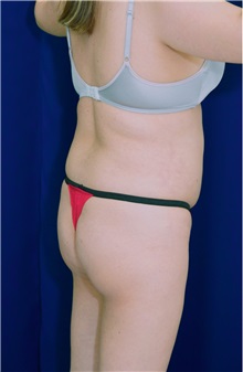 Buttock Implants Before Photo by Ricardo Rodriguez, MD; Lutherville-Timonium, MD - Case 26888