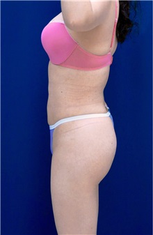 Buttock Implants After Photo by Ricardo Rodriguez, MD; Lutherville-Timonium, MD - Case 26888