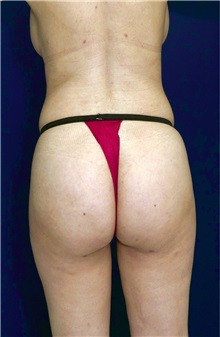 Buttock Implants After Photo by Ricardo Rodriguez, MD; Lutherville-Timonium, MD - Case 26889