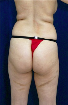 Buttock Implants Before Photo by Ricardo Rodriguez, MD; Lutherville-Timonium, MD - Case 26889