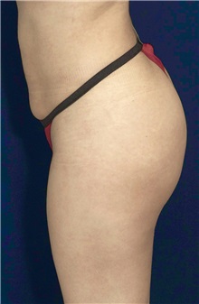 Buttock Implants After Photo by Ricardo Rodriguez, MD; Lutherville-Timonium, MD - Case 26889
