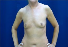 Breast Augmentation Before Photo by Ricardo Rodriguez, MD; Lutherville-Timonium, MD - Case 27004