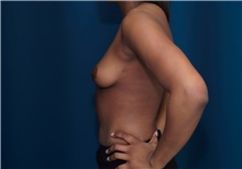 Breast Augmentation Before Photo by Ricardo Rodriguez, MD; Lutherville-Timonium, MD - Case 27005