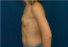 Breast Augmentation Before Photo by Ricardo Rodriguez, MD; Lutherville-Timonium, MD - Case 27009