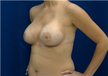 Breast Augmentation After Photo by Ricardo Rodriguez, MD; Lutherville-Timonium, MD - Case 27010