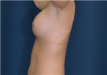 Breast Augmentation After Photo by Ricardo Rodriguez, MD; Lutherville-Timonium, MD - Case 27011