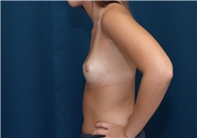 Breast Augmentation Before Photo by Ricardo Rodriguez, MD; Lutherville-Timonium, MD - Case 27011