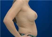 Breast Augmentation After Photo by Ricardo Rodriguez, MD; Lutherville-Timonium, MD - Case 27013