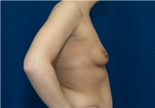 Breast Augmentation Before Photo by Ricardo Rodriguez, MD; Lutherville-Timonium, MD - Case 27013