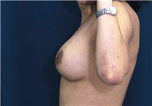 Breast Augmentation After Photo by Ricardo Rodriguez, MD; Lutherville-Timonium, MD - Case 27014