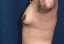 Breast Augmentation Before Photo by Ricardo Rodriguez, MD; Lutherville-Timonium, MD - Case 27014