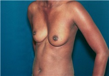 Breast Augmentation Before Photo by Ricardo Rodriguez, MD; Lutherville-Timonium, MD - Case 27015