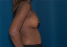 Breast Augmentation After Photo by Ricardo Rodriguez, MD; Lutherville-Timonium, MD - Case 27015