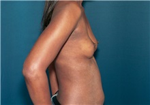 Breast Augmentation Before Photo by Ricardo Rodriguez, MD; Lutherville-Timonium, MD - Case 27015