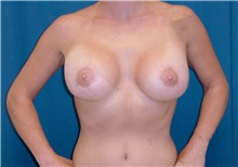 Breast Lift After Photo by Ricardo Rodriguez, MD; Lutherville-Timonium, MD - Case 27018