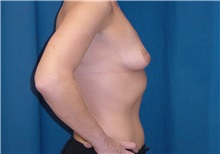 Breast Lift Before Photo by Ricardo Rodriguez, MD; Lutherville-Timonium, MD - Case 27018