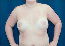 Breast Lift After Photo by Ricardo Rodriguez, MD; Lutherville-Timonium, MD - Case 27019